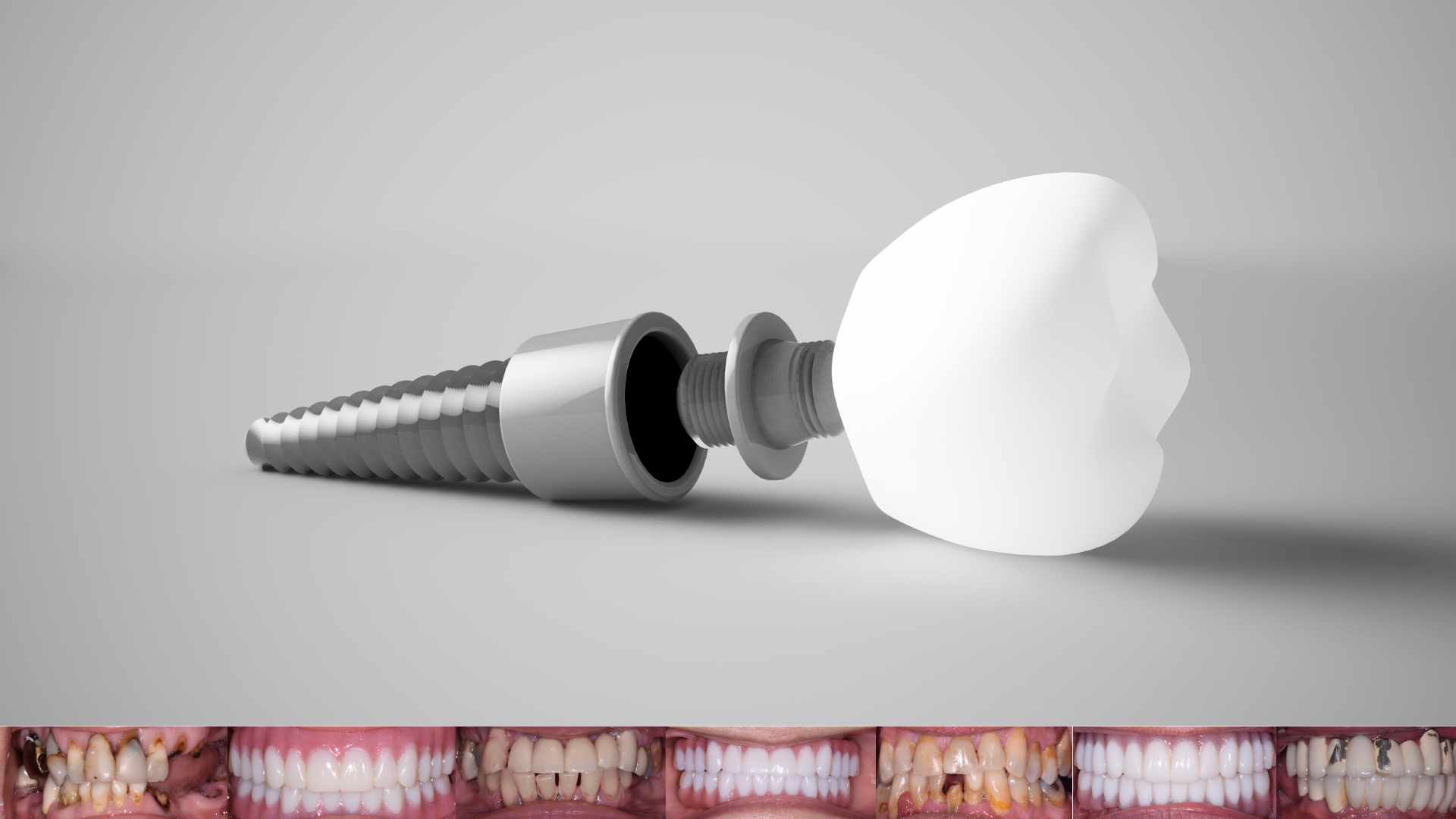 Dental Implants in Brooklyn, NY