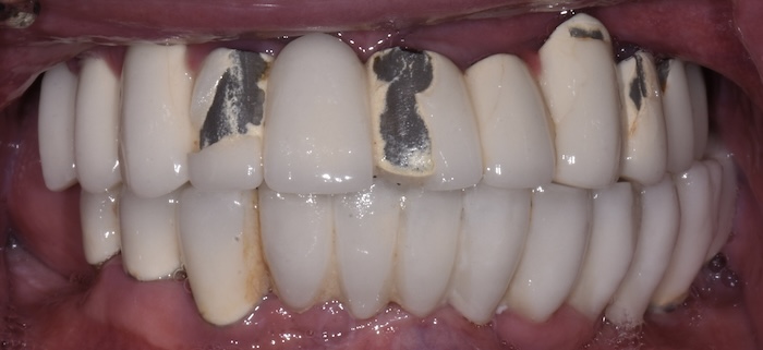 Upper and lower hybridge before