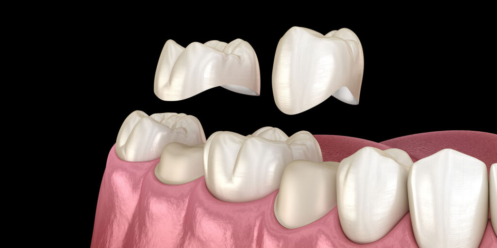 dental crown full width