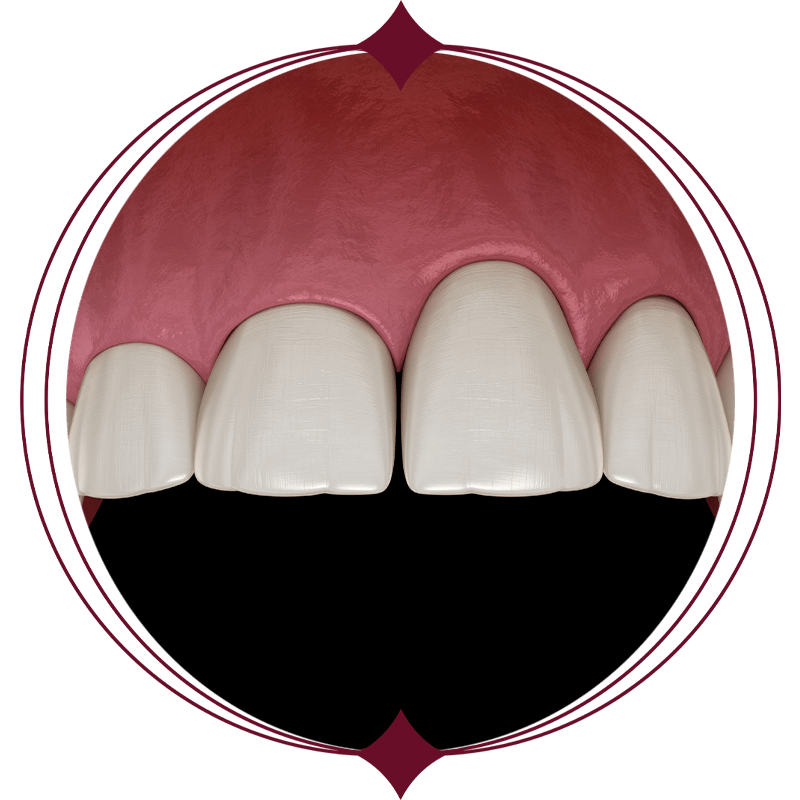 gum smile crown length