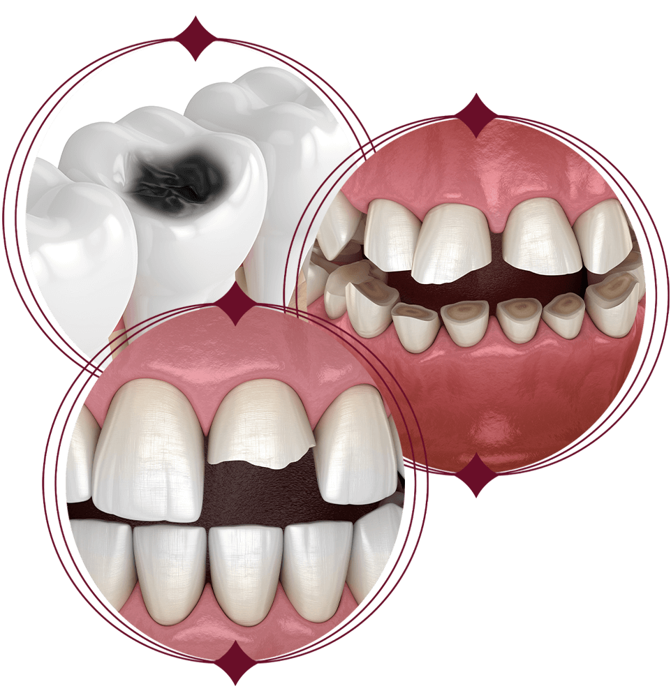Cracked teeth with decay and bruxism