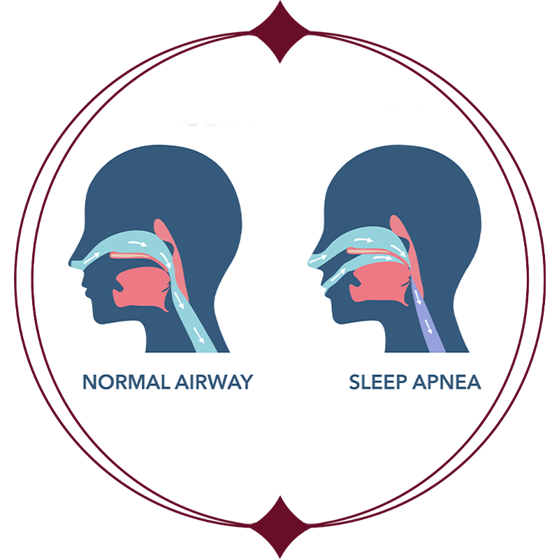 Sleep apnea