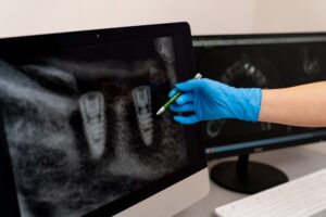 A gloved hand uses a pen to indicate two dental implants on a jaw X-ray displayed on a computer monitor. In the background, another screen shows a different radiographic image.
