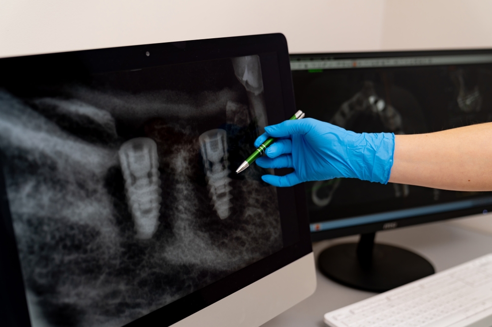 A gloved hand uses a pen to indicate two dental implants on a jaw X-ray displayed on a computer monitor. In the background, another screen shows a different radiographic image.